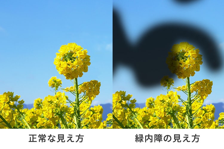 日帰り緑内障手術画像