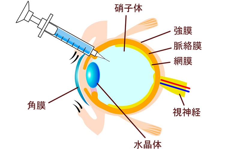 硝子体注射画像